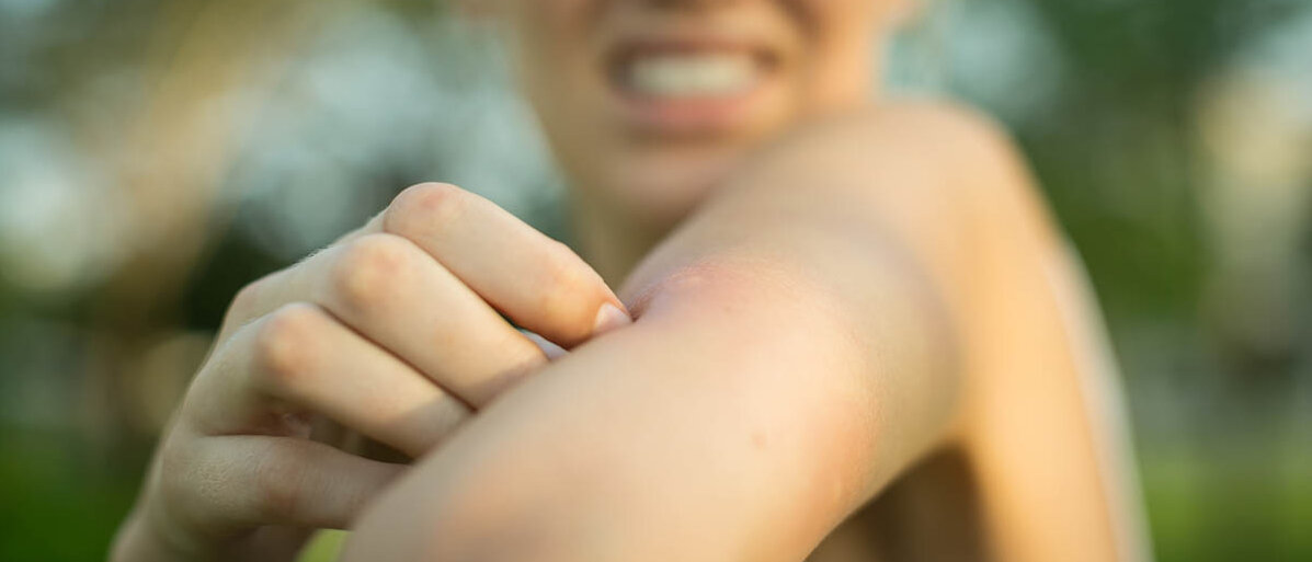 Eine Frau hat einen Insektenstich am Arm, verzerrt ihr Gesicht und kratzt am Stich.