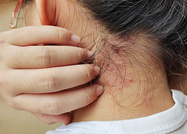 Medikamente gegen Schuppenflechte: Neuer Wirkstoff Eine Frau hat rote Psoriasis-Plagues im Nacken am Haaransatz.