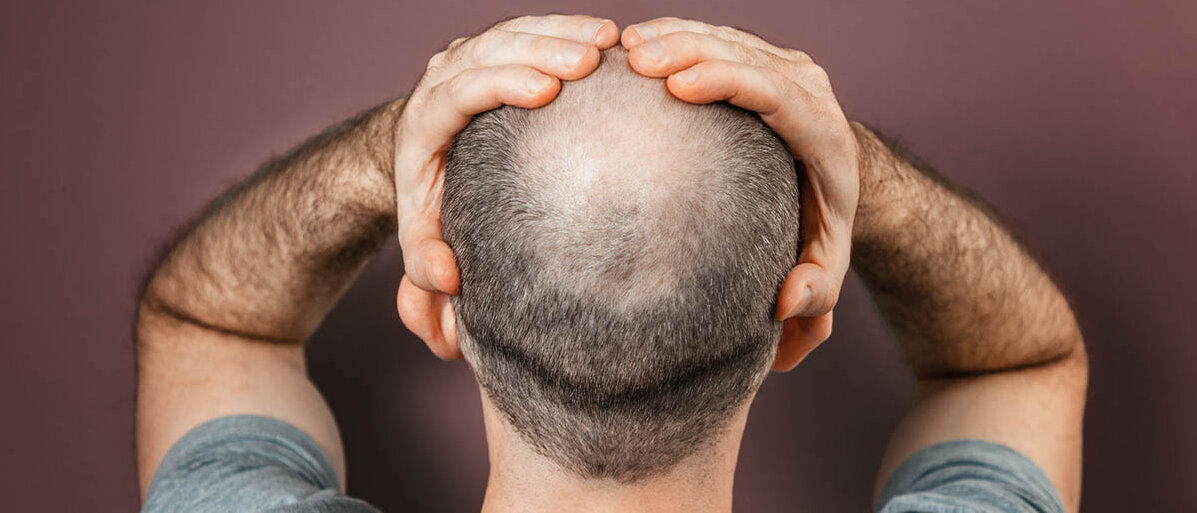 Neue Therapie bei Haarausfall mit Fettzellen Ein Mann steht mit dem Rücken zum Betrachter. Er hat die Hände über dem Kopf zusammengeschlagen. Am Hinterkopf hat er keine Haare.