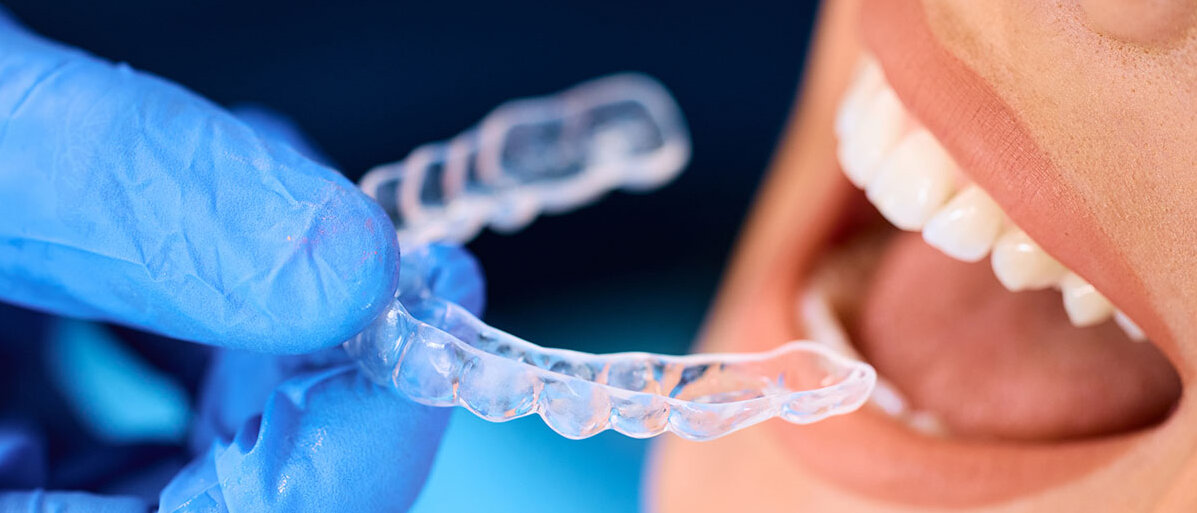 Nahaufnahme einer Frau, die während eines Termins in der Zahnarztpraxis einen kieferorthopädischen Beißschiene erhält.