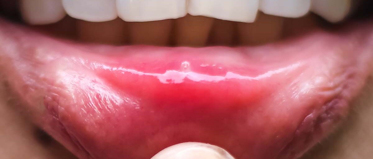 Eine Person zieht mit dem Finger die Unterlippe herunter. In der Mundschleimhaut ist ein kleines Bläschen mit rotem Wundrand zu erkennen.