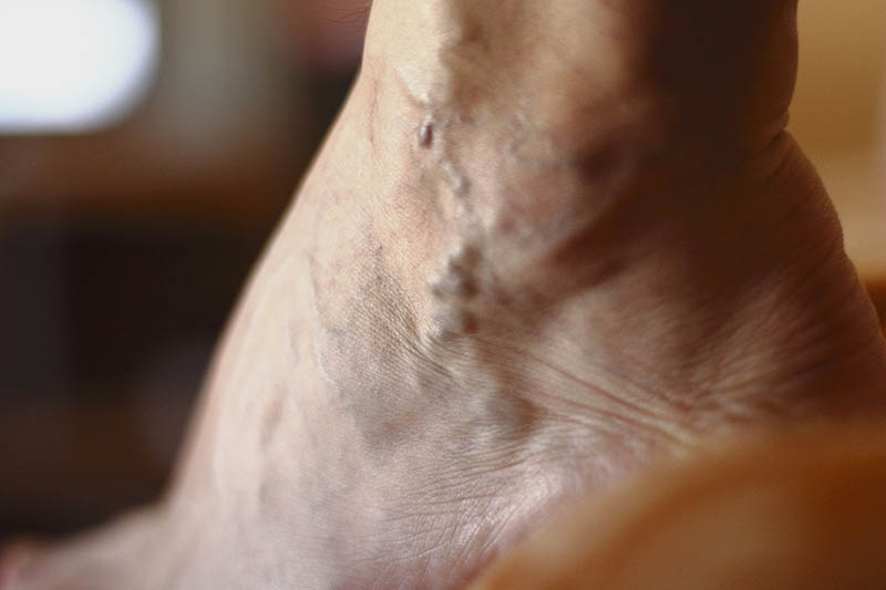 Auf einem Fuß treten eng geschwungene, blaue Adern deutlich erhaben hervor. Weitere rötliche dünne Blutgefäße sind unter der Haut zu erkennen. 