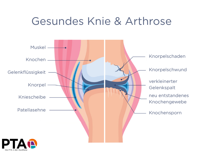 Schaubild eines Kniegelenks zum Vergleich gesund vs. Arthrose