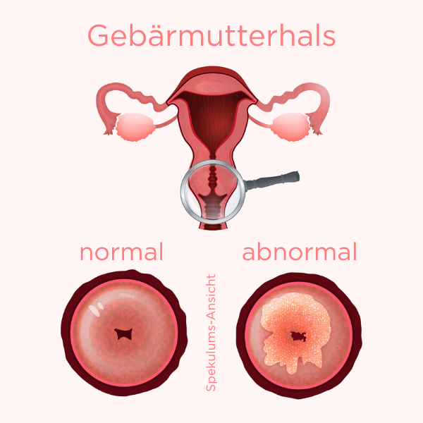 : Illustration eines Uterus mit Eierstöcken. Der vom Betracher aus linke Eierstock ist klein, oval und weist kleine Bläschen auf. Der rechte Eierstock ist groß und kugelrund.