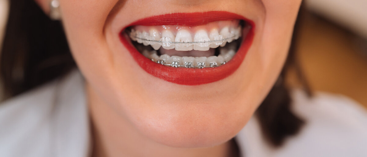 Eine Frau mit rotem Lippenstift zeigt lächelnd ihre Brackets.