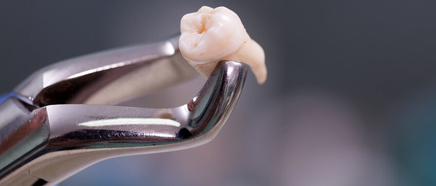 Zahnarztinstrument mit gezogenem Zahn