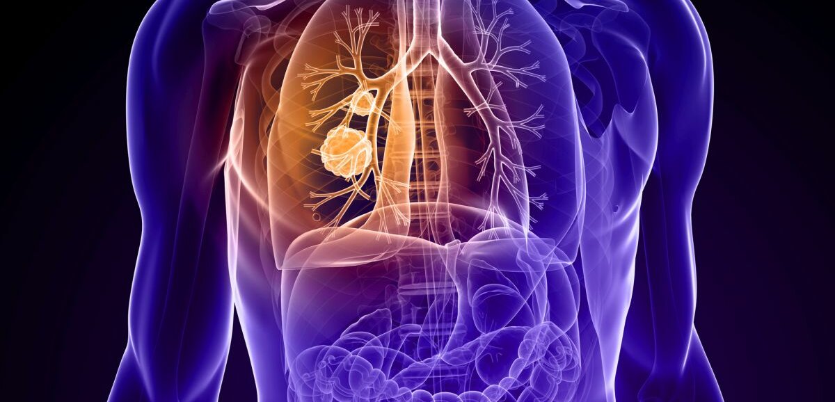 Grafisches Bild eines Oberkörpers, die Lunge mit einem Tumor ist erkennbar.