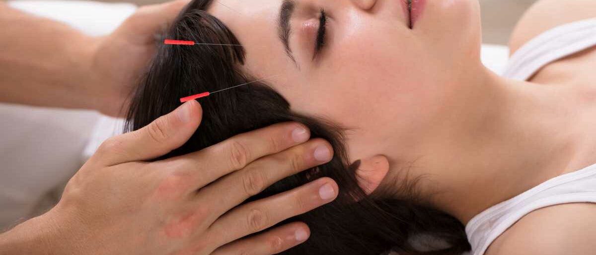 Eine Frau auf einer Behandlungsliege wird an Stirn und Kinn akupunktiert.