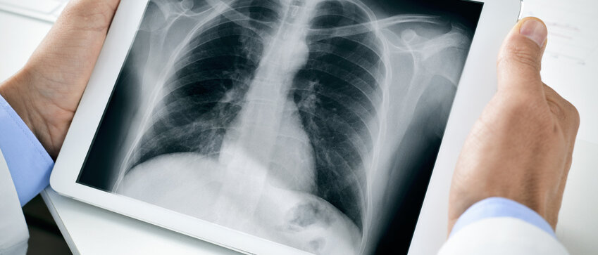 Lunge auf Röntgenbild