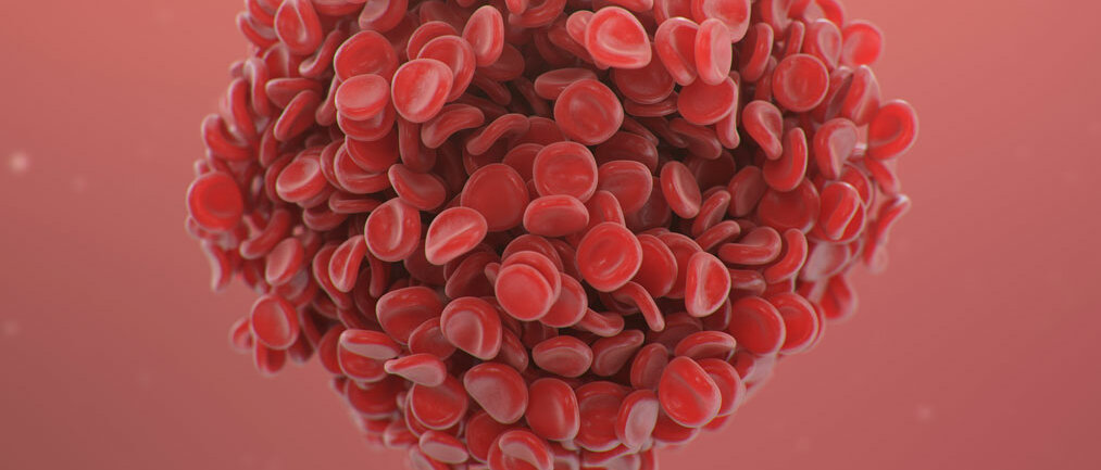 Viele rote Blutkörperchen haben sich zu einem großen Klumpen zusammengelagert.