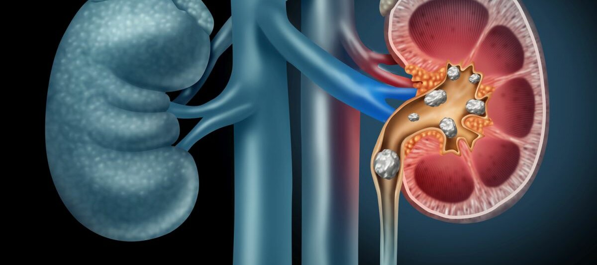 Grafisches Bild der Nieren mit Nierensteinen.